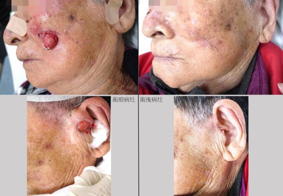 80多歲吳姓阿嬤鼻梁、臉頰、耳前長出帶血腫塊，經檢查後是皮膚癌，經手術後完全切除、不留痕跡。 （安南醫院提供）