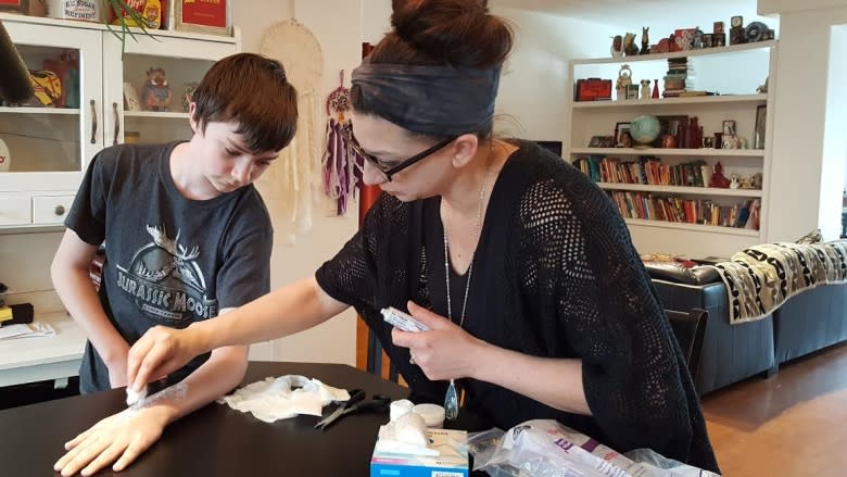 Sask. mom speaks out after boy, 12, severely burned having cast removed