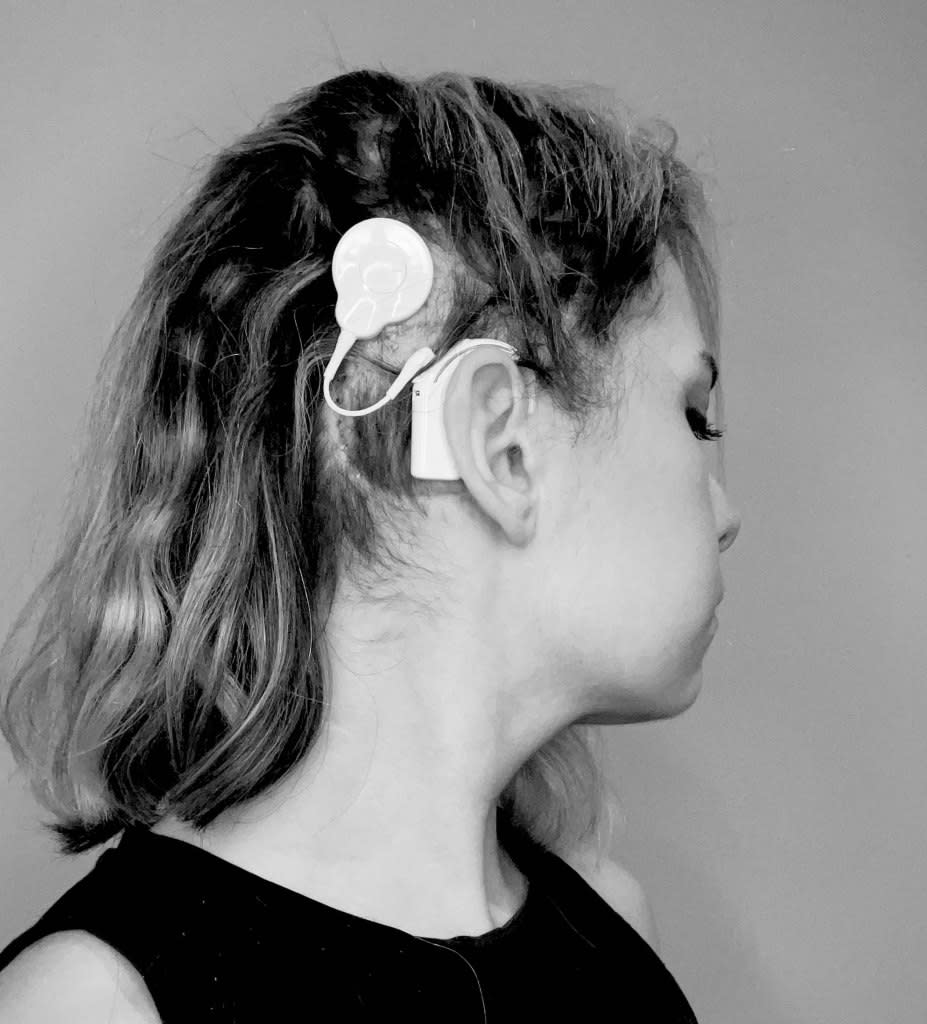 Scaglione now has an auditory brainstem implant installed.