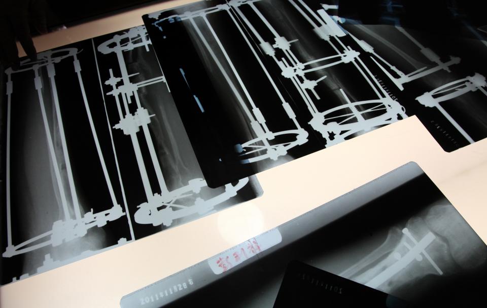 X rays of chinese patients after surgery at the Institute of External Skeletal Fixation, an hospital specialized in legs lengthening surgeries on January 16, 2012 in Beijing, China. Limb lengthening is an orthopaedic procedure that gained popularity in the late 1980s in the United States. The technology is based on the principle of bone regeneration, meaning that a bone can be cut, gradually pulled apart and grows together again. Legs lengthening can be no more than 10 cm for the tibia or lower leg bone, or 8 cm for a femur or thighbone. (Photo by Olivier CHOUCHANA/Gamma-Rapho via Getty Images)