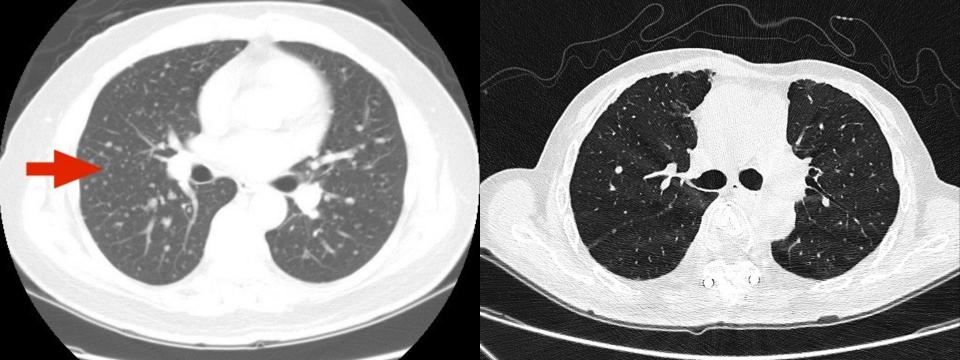 (左)電腦斷層顯示，兩肺一度出現瀰漫性轉移病灶。(右)經標靶治療後，電腦斷層顯示肺部轉移病灶已完全消失。