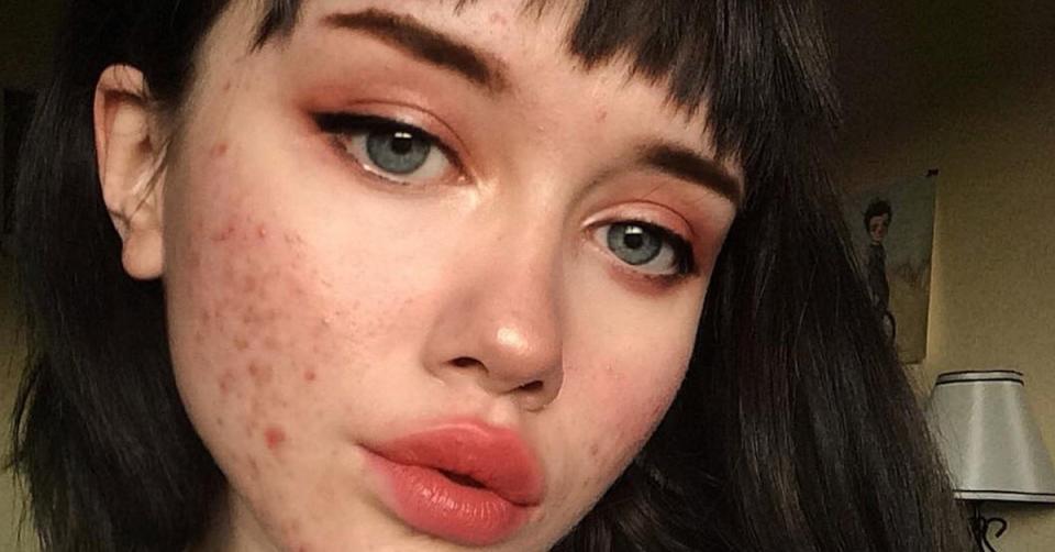 Una blogger muestra su rostró lleno de acné como ejemplo para aceptar estas ‘imperfecciones’. (Foto: Instagram)