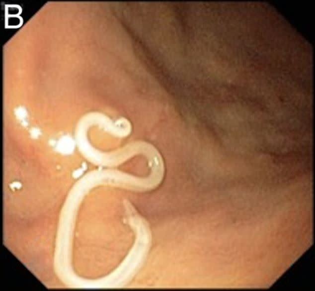 The 32-year-old man was admitted to hospital after a week of symptoms, including stomach pain (BMJ Case Reports) 