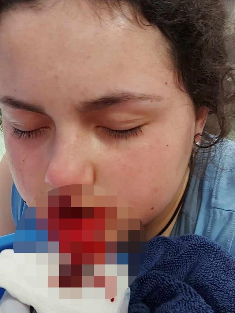 Niki Chrysanthopolous arrived home from school on Thursday afternoon and was eating a snack when her American bull-terrier, Ollie, snapped and attacked her. Picture: Supplied
