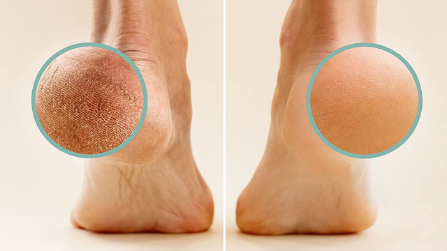 The Best Callus Remover to Get Your Feet Ready for Sandal Weather