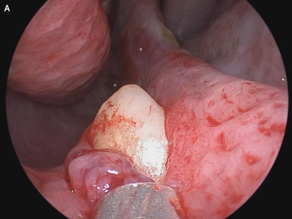 The ectopic tooth in question that grew on the floor of the man’s septum or the cartilage that separates the nostrils (The New England Journal of Medicine)