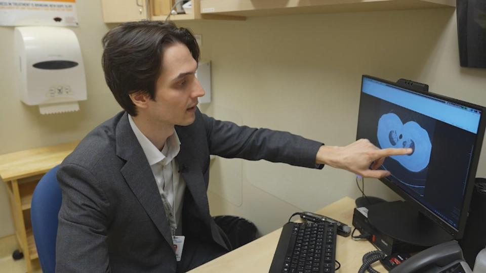 Respirologist Dr. Daniel Marinescu examines a patient's CT scan. He points out scarring on the lungs that can occur after severe cases of COVID-19. (CBC News - image credit)