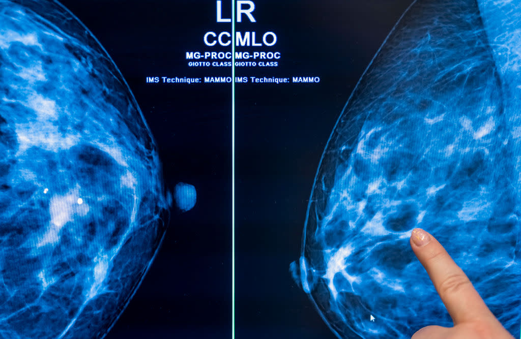 Mammography