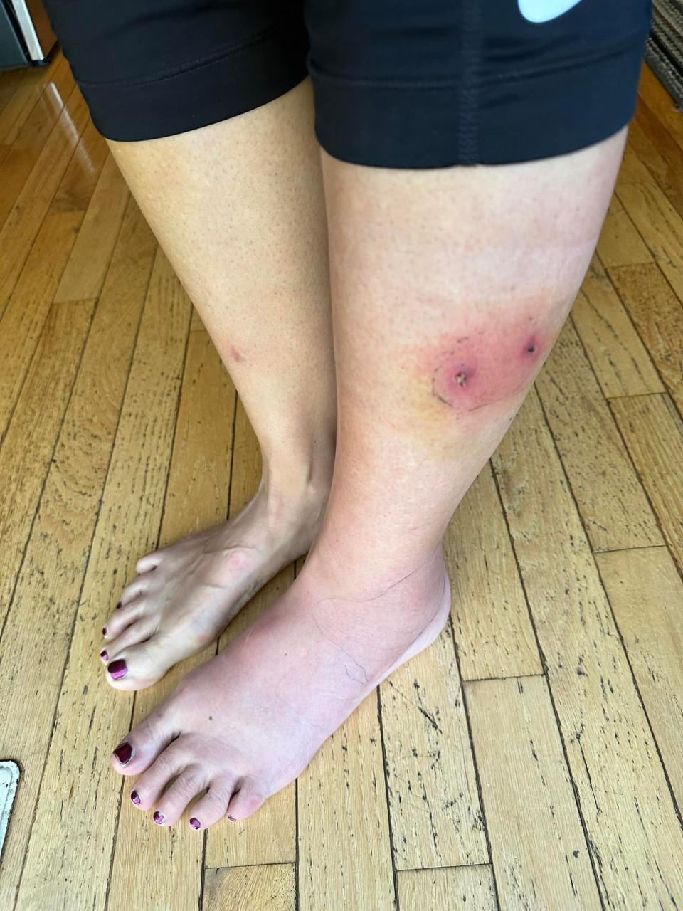 Topeka Kim Teske posted this photo on her personal Facebook page showing an injury she received when a dog bit her as she rode her bicycle on the Shunga Trail in East Topeka.