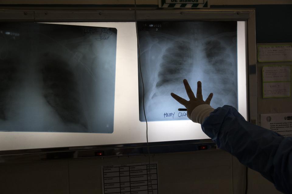Dr Claudio Yataco examines chest X-rays in an intensive care unit for people infected with the new coronavirus, at the 2 de Mayo Hospital, in Lima, Peru, Friday, April 17, 2020. (AP Photo/Rodrigo Abd)