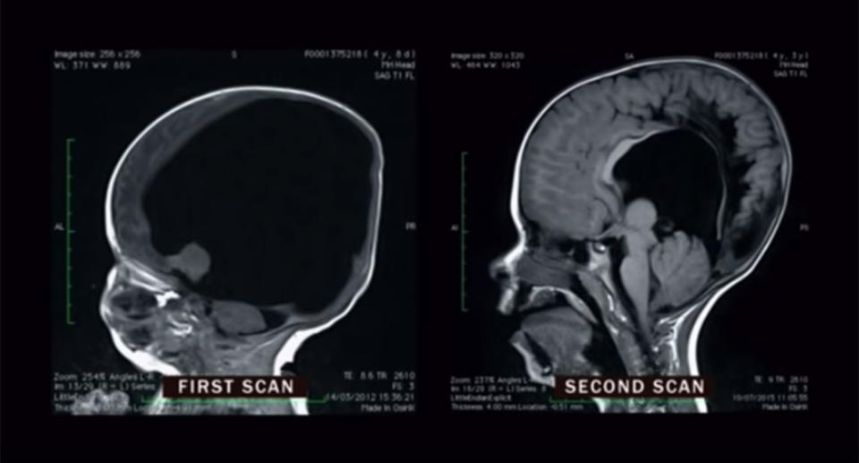 A baby born with ‘no brain’ is baffling medical professionals who say it ‘grew’ to 80 per cent by the time he was three. Source: Channel5