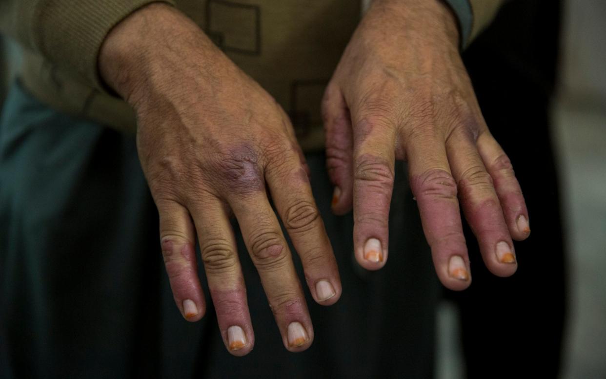 Darwesh Khan gets treated for Leishmaniasis at the Naseerullah Babar Memorial Hospital in Peshawar, Pakistan - Saiyna Bashir /The Telegraph