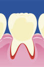 <p>Severe gum disease, aka periodontitis, can be an early sign of type 2 diabetes, according to a <a rel="nofollow noopener" href="http://drc.bmj.com/content/bmjdrc/5/1/e000326.full.pdf" target="_blank" data-ylk="slk:February 2017 study;elm:context_link;itc:0;sec:content-canvas" class="link ">February 2017 study</a>. Researchers looked at over 300 middle-aged adults and found those with severe gum disease - roughly a quarter of participants - were at a higher risk for diabetes because they were more likely to be overweight, with an average BMI of 27 or higher. Nearly one in five of those with periodontitis had previously undiagnosed type 2 diabetes, compared with 10%t of those with mild to moderate gum disease and 8.5% with no gum disease. What's the connection? People with diabetes are more susceptible to contracting infections, according to the <a rel="nofollow noopener" href="https://www.perio.org/consumer/diabetes.htm" target="_blank" data-ylk="slk:American Academy of Periodontology;elm:context_link;itc:0;sec:content-canvas" class="link ">American Academy of Periodontology</a>.<br></p>