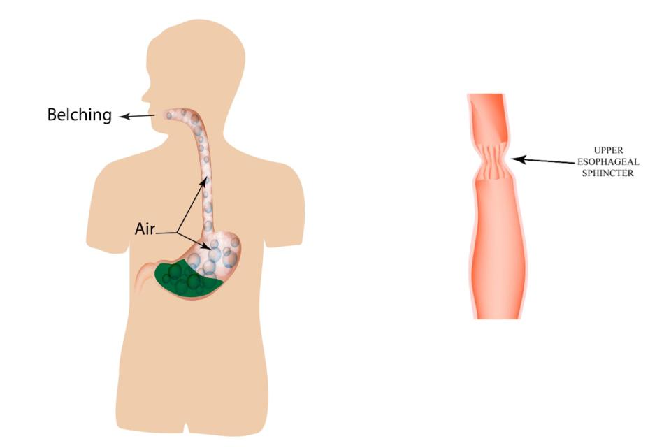 A burp is gas that’s risen up to your mouth from your stomach via your esophagus. The sphincter at the top of your esophagus is like a gate that either keeps that gas in or lets it free. <a href="https://www.shutterstock.com/image-illustration/belching-air-stomach-structure-esophagus-infographics-386247529" rel="nofollow noopener" target="_blank" data-ylk="slk:Timonina/Shutterstock.com;elm:context_link;itc:0;sec:content-canvas" class="link ">Timonina/Shutterstock.com</a>