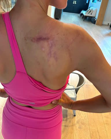 <p>Teddi Mellencamp/Instagram</p> Teddi Mellencamp shares a photo of an affected area of her skin