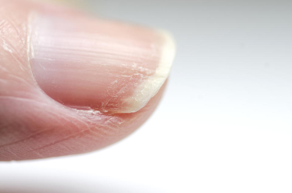 Close-up of brittle nails. Damage to the nails after using polish. Peeling on the nails. Damage to the nail. Shattered nails.