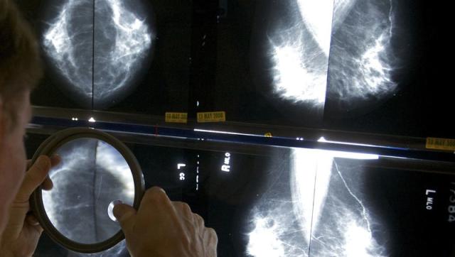 Women now recommended to begin mammograms at 40