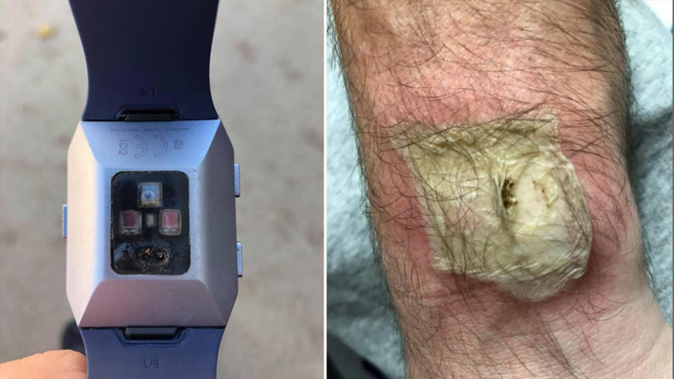 The damaged Fitbit (left) explodes on a mans wrist leaving a third-degree burn (right).