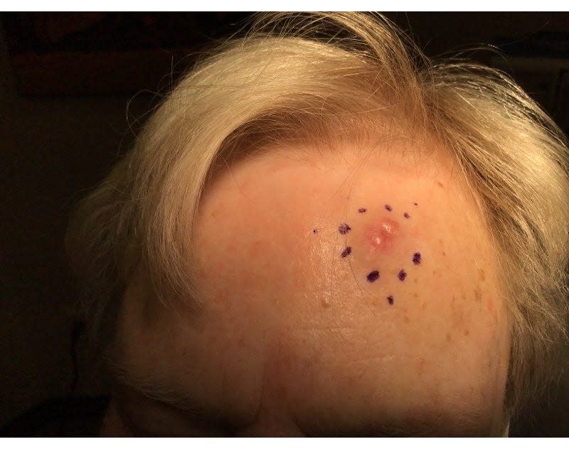 Merkel cell carcinoma looks like a red or blue glossy bump on the skin.