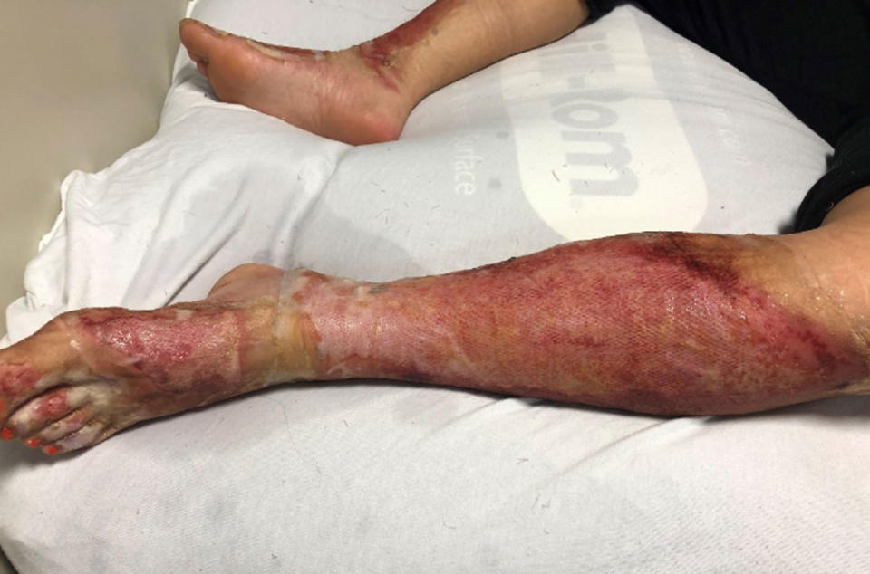 Rebecca Rogers' burnt legs from an exploding gas tank.