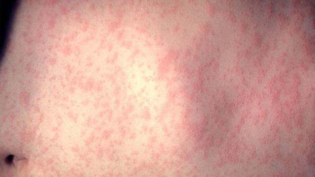 10 measles cases identified in Quebec, 7 in Montreal, public health  officials say