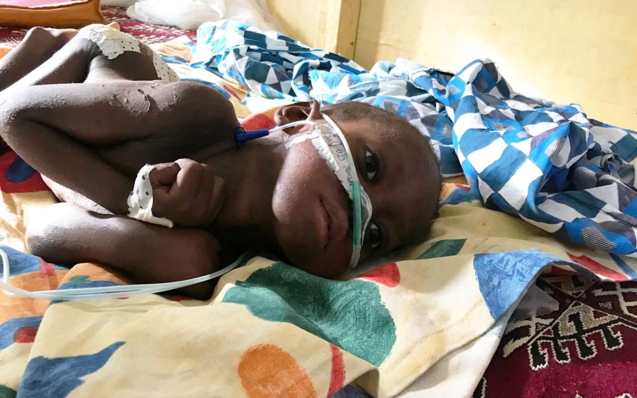 Ezechiel was abandoned by his parents and is suferingng from severe malnutrition  - Todd Pitock