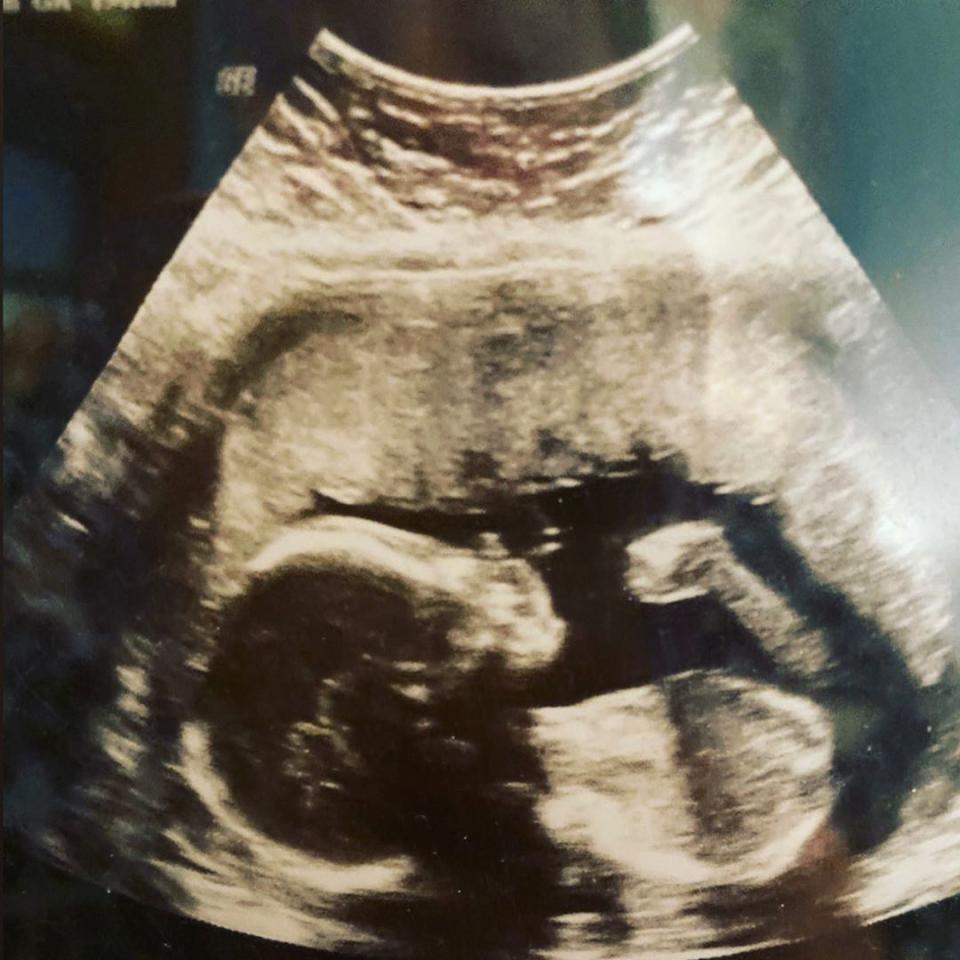 Catelynn Lowell's ultrasound