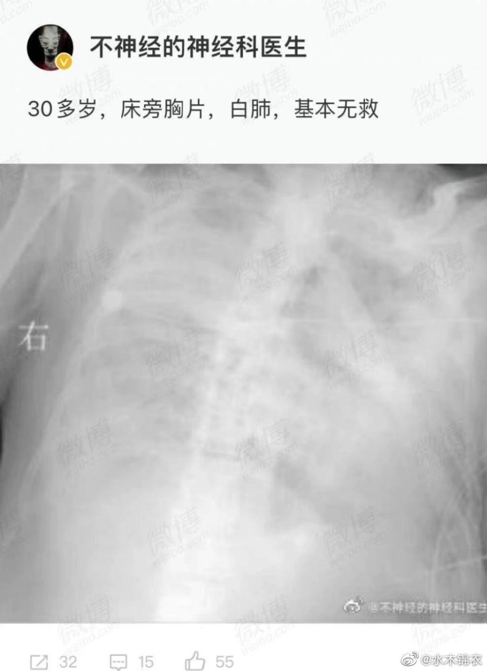 網傳許多「大白肺」圖片，中共官方趕緊闢謠。   圖：翻攝自搜狐（資料照）