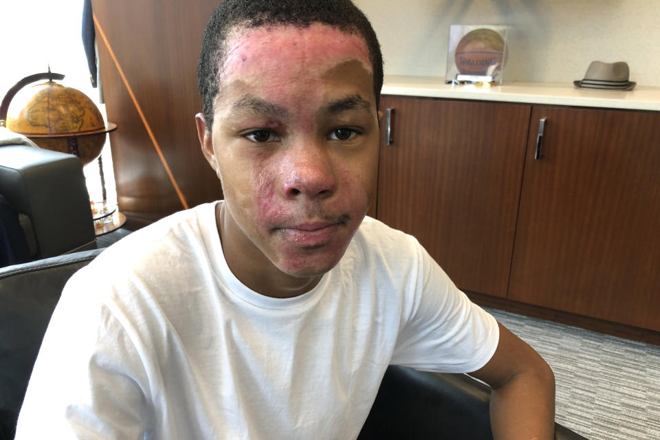 In this Sept. 12, 2019 photo, Malachi McFadden, 16, who suffered serious burns during a chemistry class demonstration on Aug. 6, poses for a photo at his lawyer's office, in Atlanta. Lawyers for McFadden, a student who was burned during a chemistry class demonstration have released a report, Wednesday, Nov. 6, 2019, saying his teacher violated school district standards. (AP Photo/Kate Brumback)