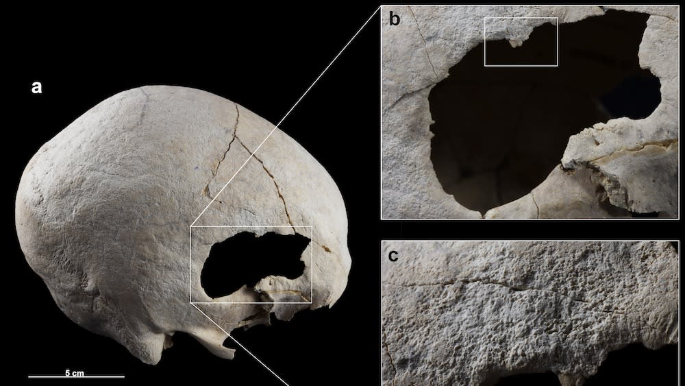  A skull with a hole in it (at right) and magnified images of the hole and scrape marks (at left). 