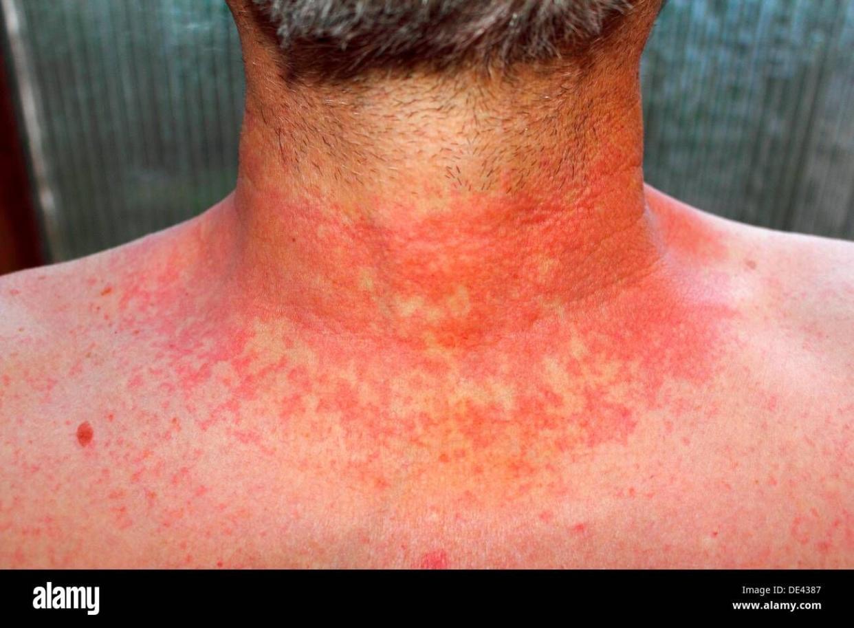 de4387 dermititis should be dermatitisred skin rash on a man4s neck and chest due to scarlet fever, fever, dermatitis or eczema