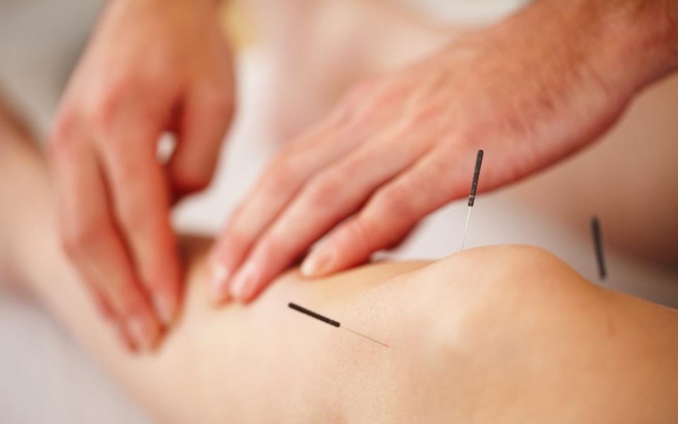 Acupuncture should be used to treat chronic pain rather than opiates, according to new guidance for GPs and sufferers. - Getty 