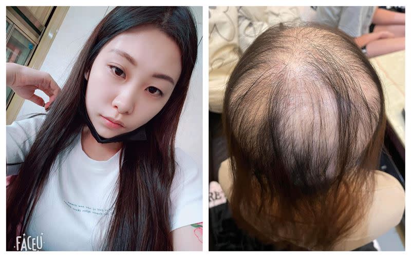 27歲女子琪琪打了一劑莫德納疫苗後頭髮掉光。（圖／翻攝自爆料公社）