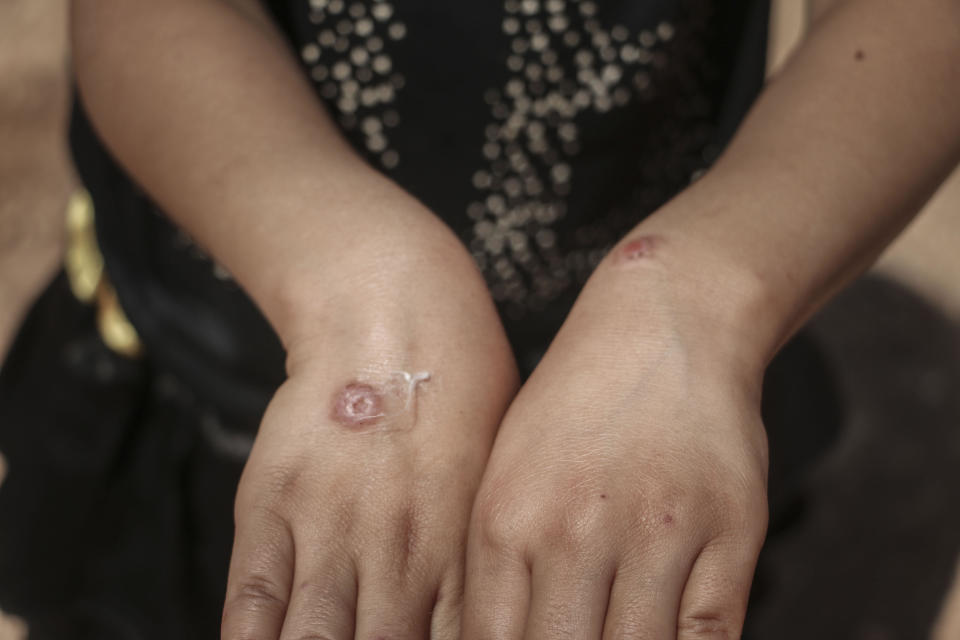 A child suffering from leishmaniasis, a parasitic disease spread by the bite of phlebotomine sand flies, shows the lesions on her hands in a refugee camp in Idlib, Syria, on July 2, 2020. / Credit: Muhammed Abdullah/Anadolu Agency via Getty Images