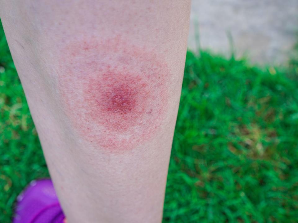 A red bull's-eye shaped rash on a person's leg.