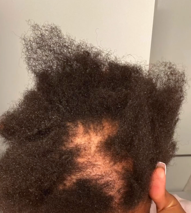 Drea Okeke’s traction alopecia in 2020.