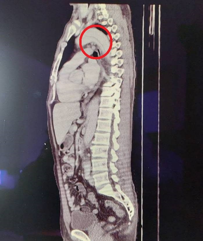 劉先生經電腦斷層檢查，發現為急性主動脈剝離(紅圈處)。大千醫院提供