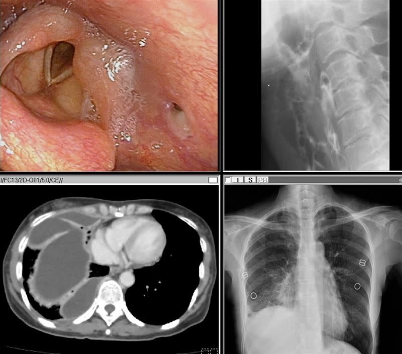 60歲婦人出現喉嚨痛、吞嚥有異物感，甚至發高燒，經過電腦斷層掃描檢查，竟是咽喉黏膜穿孔導致細菌感染發炎產生多處器官膿瘍，差點引發全身性敗血症。(圖／台中醫院提供)