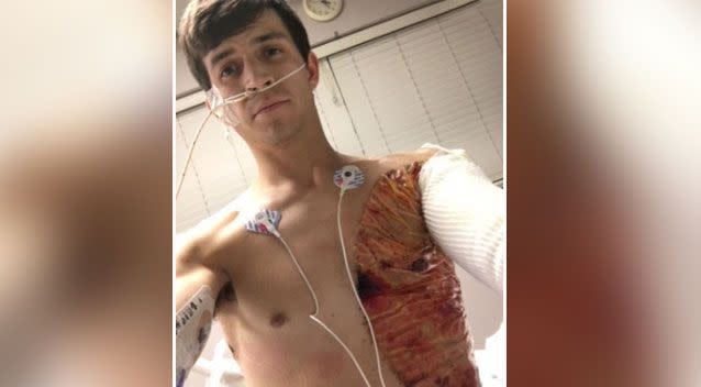 Caleb Dunn suffered third degree burns to a quarter of his body after a stray cigarette landed on his jumper. Source: Caleb Dunn/ Katu 2