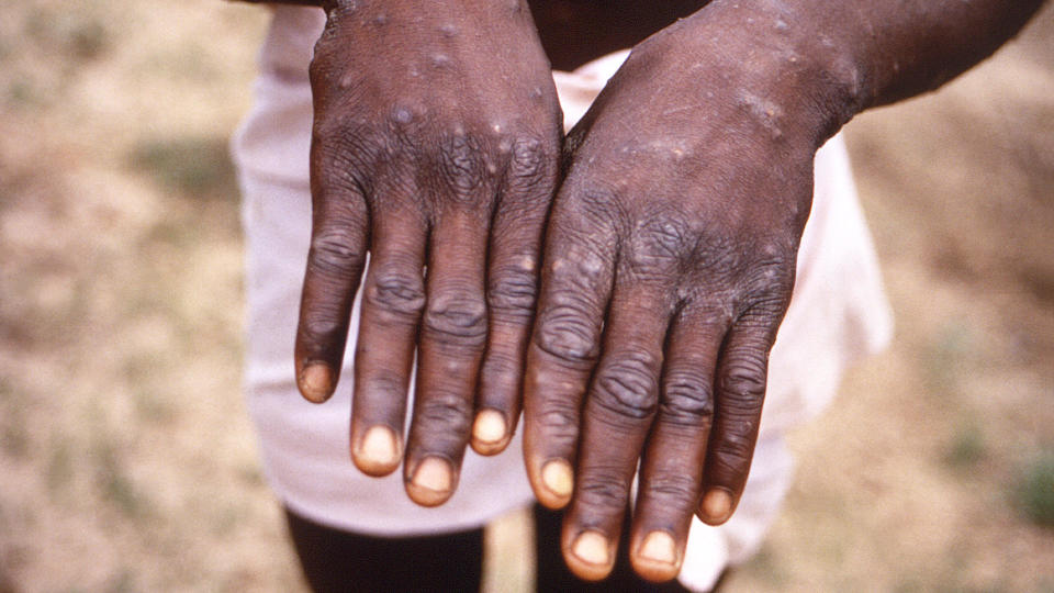 Close-up of monkeypox lesions on the hands of a patient in the Democratic Republic of the Congo.  / Credit: Courtesy CDC/Mahy et al. via Smith Collection/Gado/Getty Images