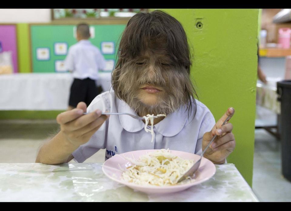 Supatra Sasuphan eats lunch in Ratchabophit school in Bangkok, Thailand on February 28, 2011.  After Supatra was named the 'hairiest girl in the world' by Guinness, she says that getting the award has boosted her confidence and she has taken up dancing, singing, and acting. She loves listening to Thai pop music and makes her own dance routines to the latest hits with her friends.