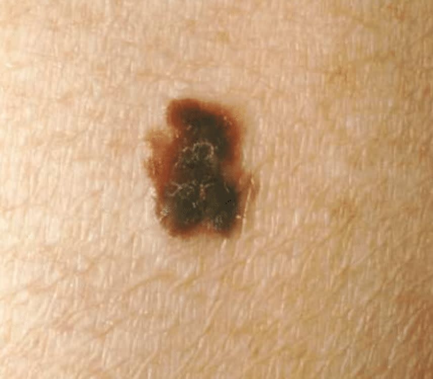 A mole with an irregular border may have scalloped or notched edges. 