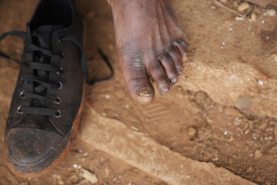 A street vendor takes off his shoes to show his toes on the streets of Harare, Zimbabwe, Thursday, June, 9, 2022. Rampant inflation is making it increasingly difficult for people in Zimbabwe to make ends meet. Since the start of Russia’s war in Ukraine, official statistics show that Zimbabwe’s inflation rate has shot up from 66% to more than 130%. The country's finance minister says the impact of the Ukraine war is heaping problems on the already fragile economy. (AP Photo/Tsvangirayi Mukwazhi)