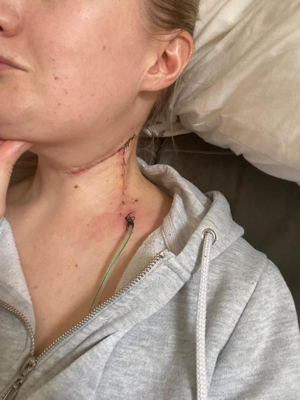 Lee said the surgery to remove 24 lymph nodes from her neck 