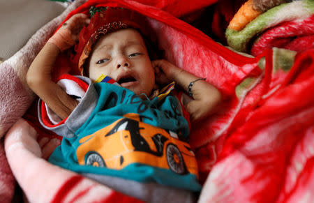 A malnourished girl lies on a bed at a malnutrition treatment center in Sanaa, Yemen November 21, 2017. REUTERS/Khaled Abdullah