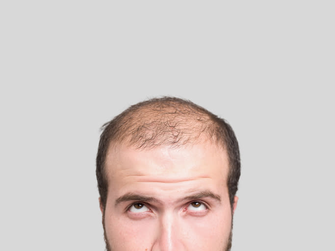 La calvicie masculina puede afectar negativamente la autoestima de los hombres. – Foto: ozgurdonmaz/Getty Images