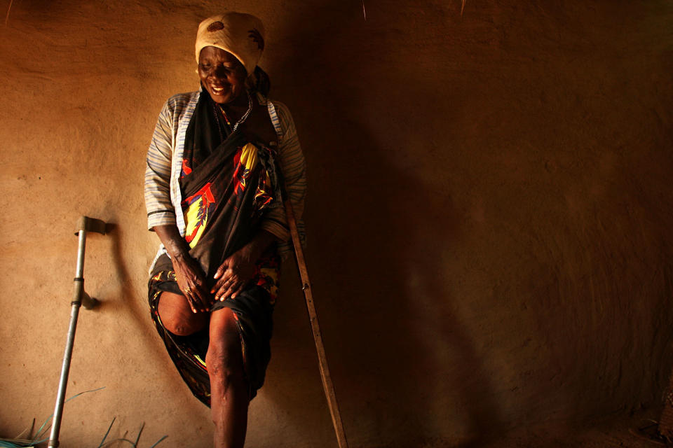 Mako Bakar Bakaro, who lost a leg in fighting in Mogadishu, Somalia in 2008, stands against the wall of her hut August 21, 2009 in a refugee complex in Dadaab, Kenya.&nbsp;