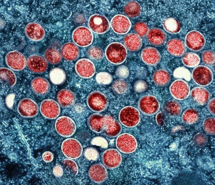 This image provided by the National Institute of Allergy and Infectious Diseases shows a colorized transmission electron micrograph of monkeypox particles , in red, found within an infected cell, blue, cultured in a laboratory.
