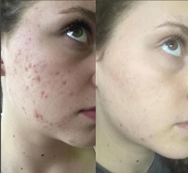@vanessaolyy Before and after using Frank original scrub. Photo: Instagram