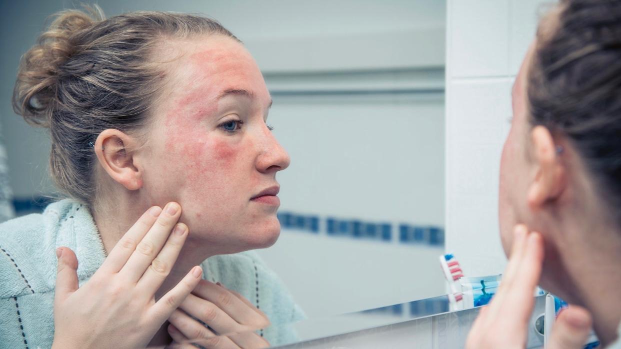 how to treat rosacea